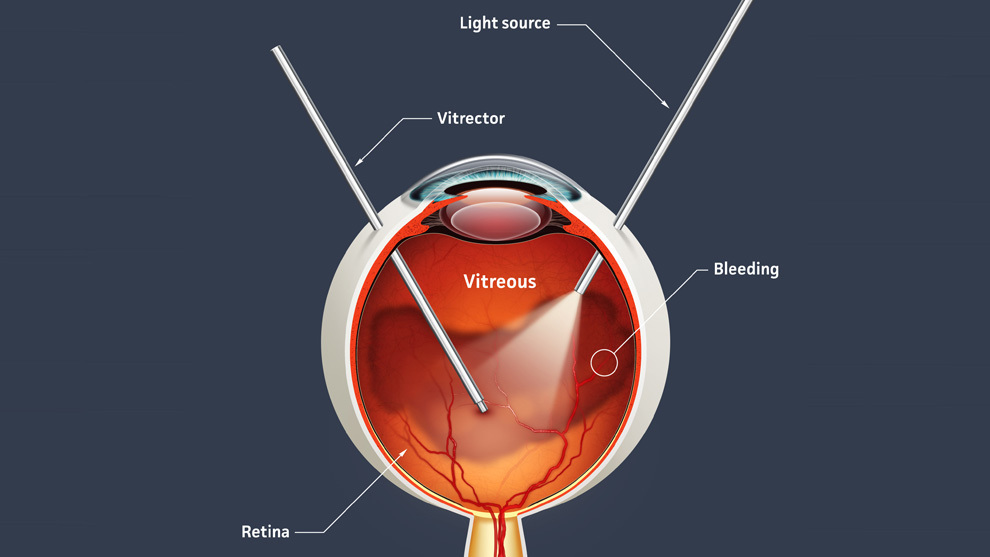 Vitrectomy In Patients With Uveitis Vitrectomy In Patients With Uveitis